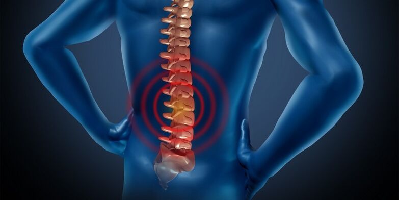 Остеохондроза на лумбалната област